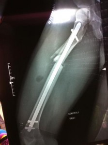 Tracey still has a rod in her leg after the accident